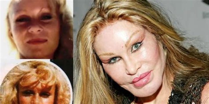 Catwoman With Plastic Surgery