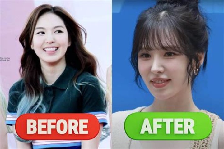 Red Velvet Wendy Plastic Surgery, Nose Job Before And After Photos