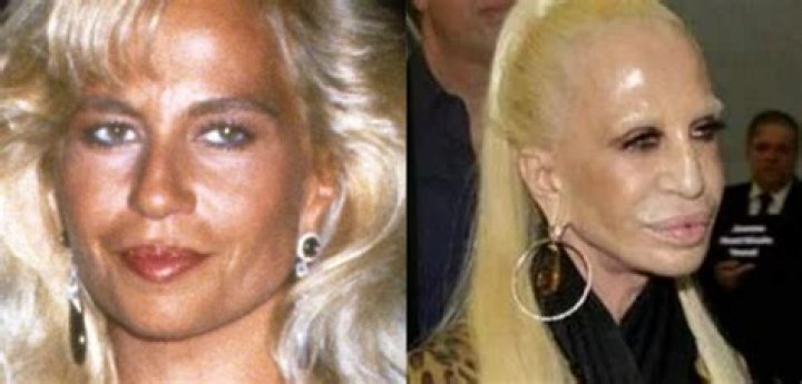 Versace Before And After Plastic Surgery